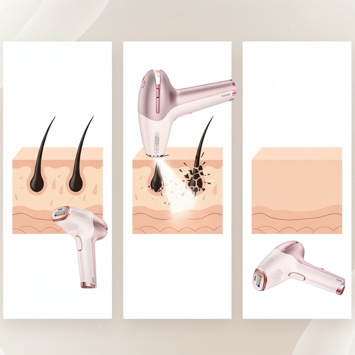 BOSTE IPL lazerinis epiliatorius nuolatinis epiliavimas su odos jutikliu ir vėsinimu